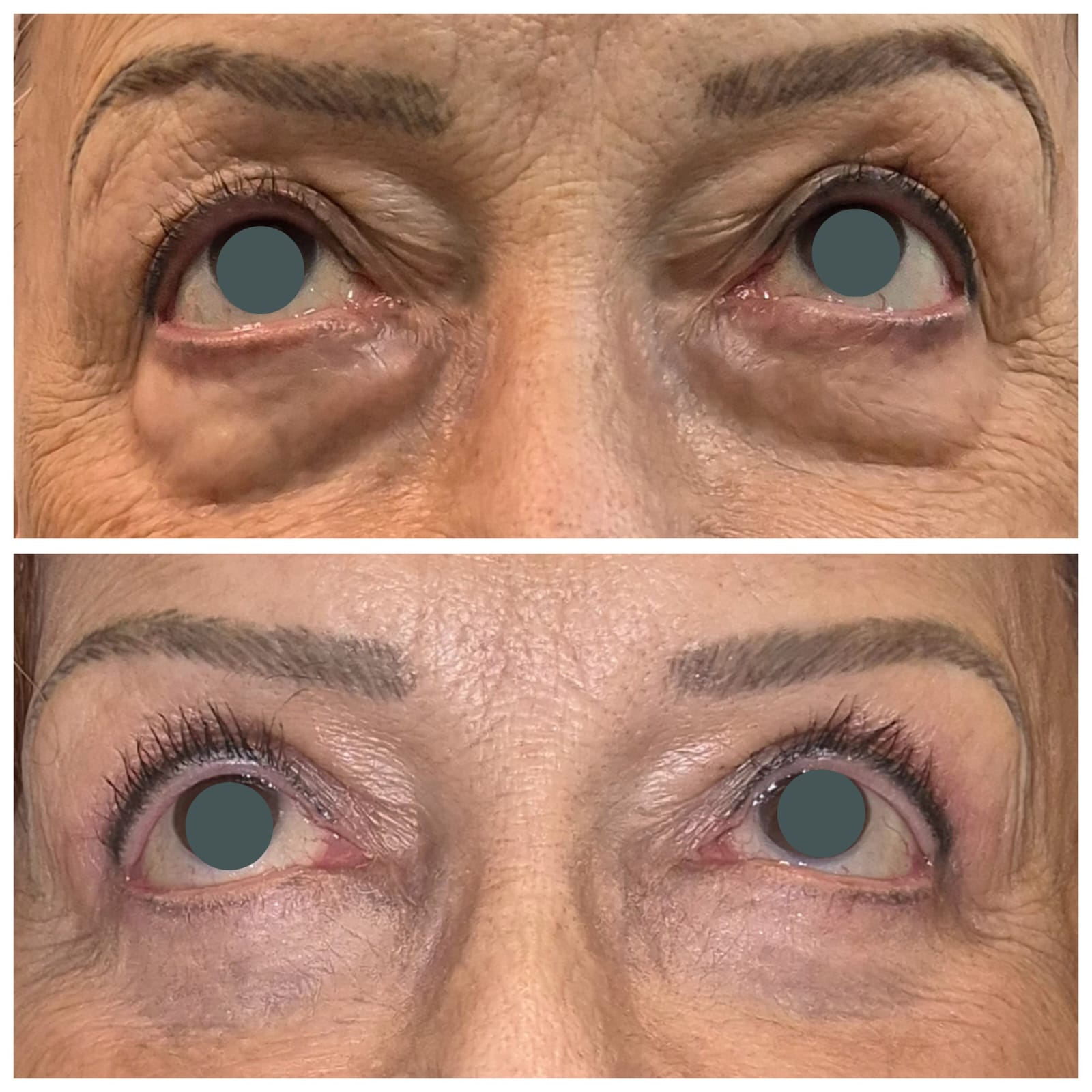 Detalhe da pálpebra inferior antes e depois